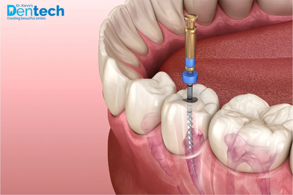 Root Canal Treatment Complete Guide